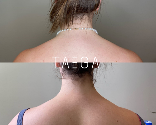 Trapz Slimming Before After