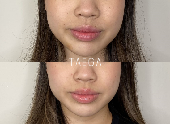 Before After Lemon Bottle 1
