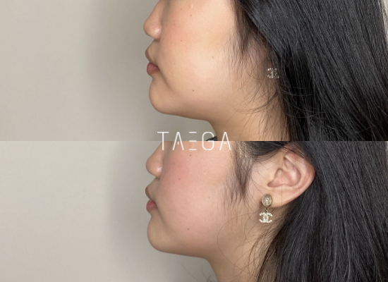 Before After Lemon Bottle 3