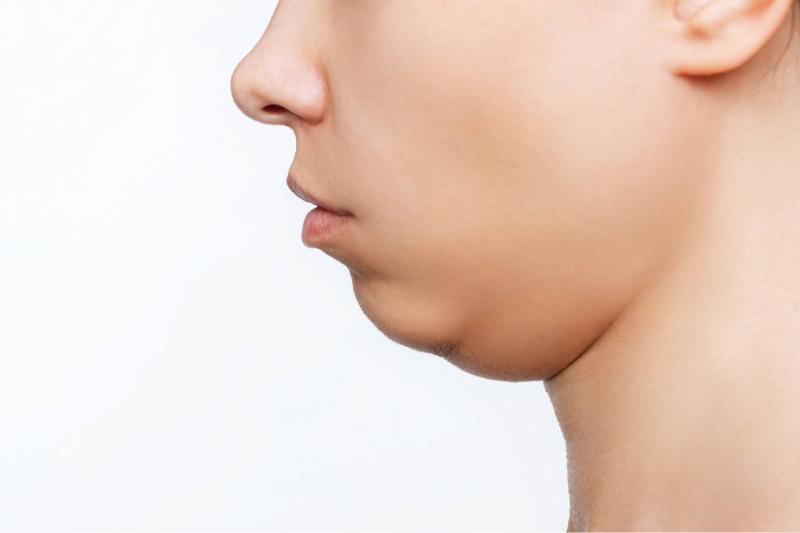 Reasons cause to a double chin