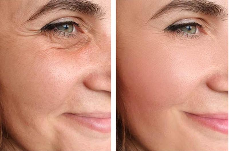 Understanding Non surgical Face Lift