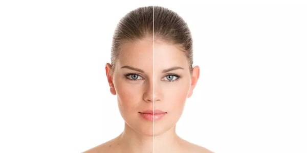 What is Pigmentation Treatment?