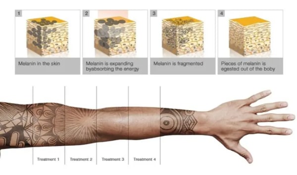 The number of laser treatment sessions you need for your individual goa