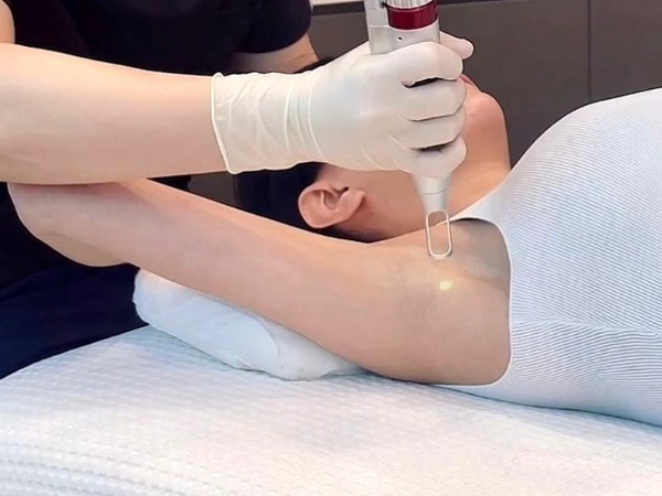 q switch laser underarm