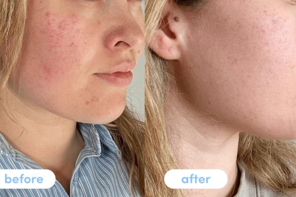 collagen for acne scars