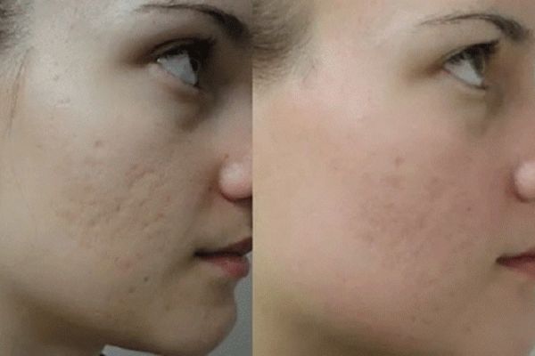 collagen for acne scars