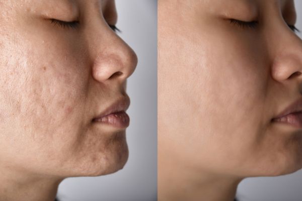 collagen for acne scars