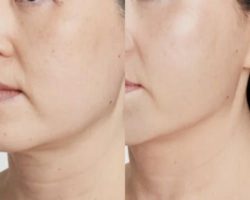 Ultherapy Before After
