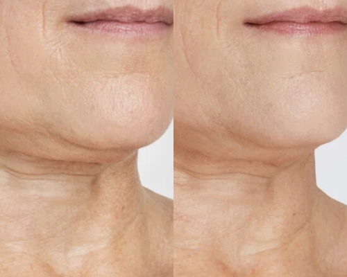 Ultherapy Before After