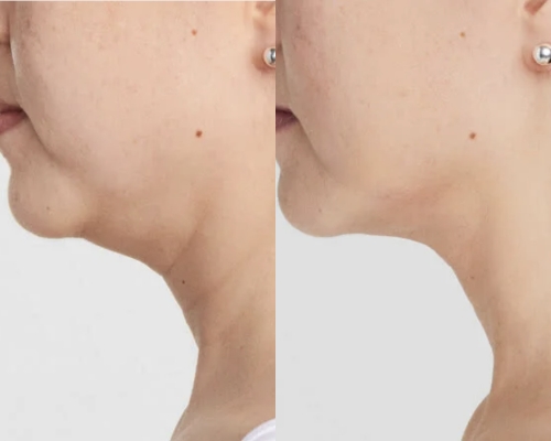 Ultherapy Before After