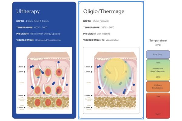 thermage flx vs ultherapy prime
