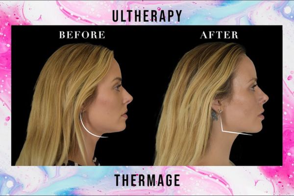 thermage flx vs ultherapy prime