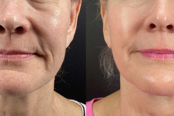 ultherapy prime