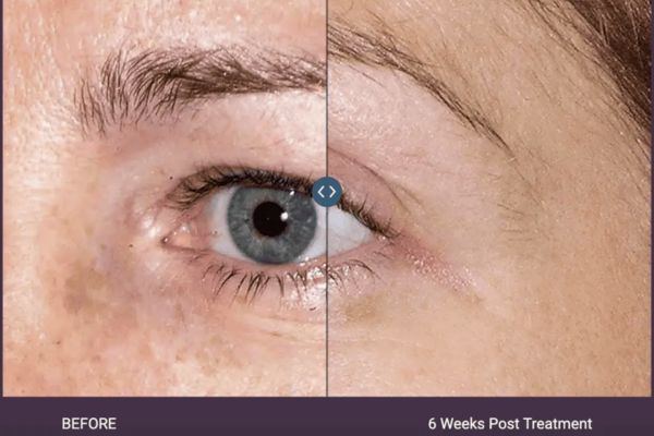 thermage flx vs ultherapy prime