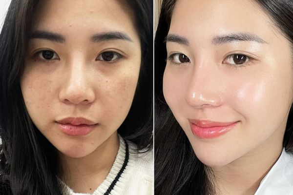 dermashine pro injector