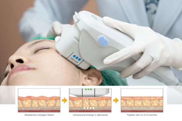 ultherapy prime