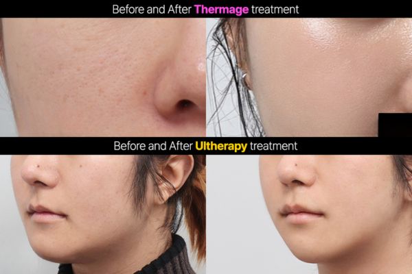 thermage flx vs ultherapy prime