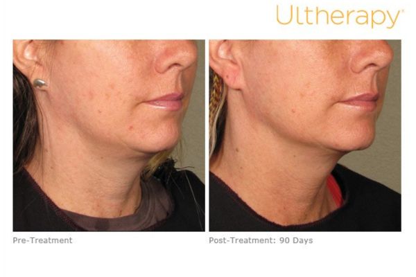 visible jawline improvement after ultherapy