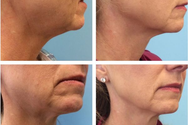 side by side comparisons of before and after the treatment