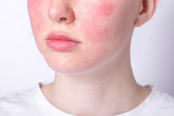 redness on skin after treatment