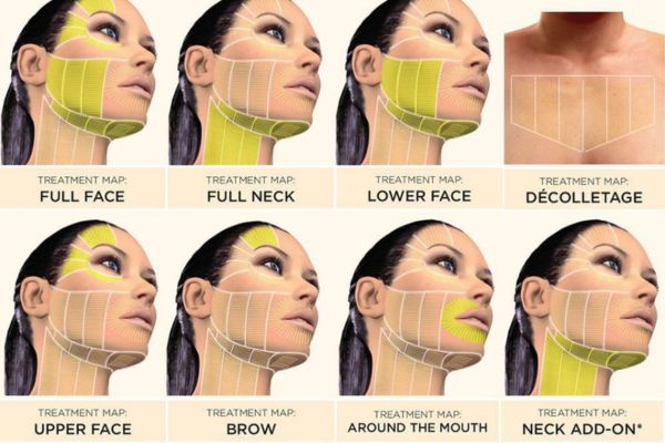 treatment zones for ultherapy