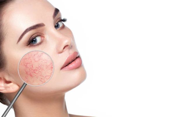 how long does it take for the skin to heal from ultherapy