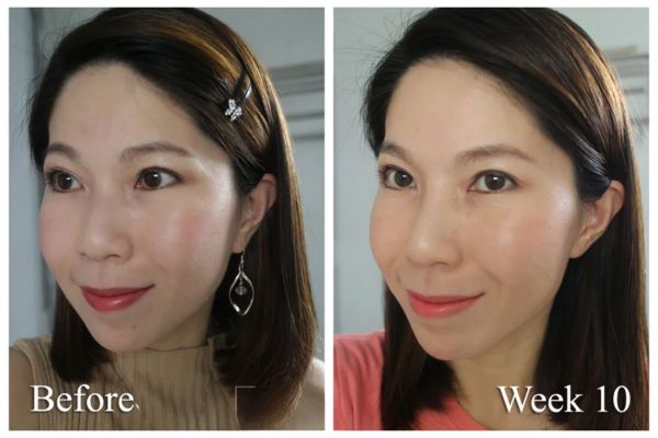 Face ultherapy before and after
