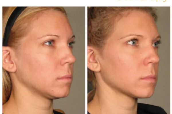 Jawline ultherapy before and after