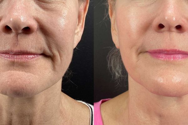 Nasolabial Ultherapy before and after