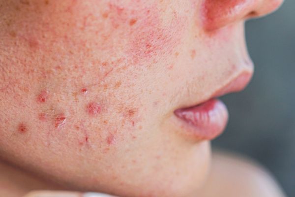 aftercare can help prevent ultherapy side effects