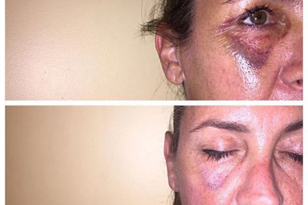 potential severe side effects of ultherapy