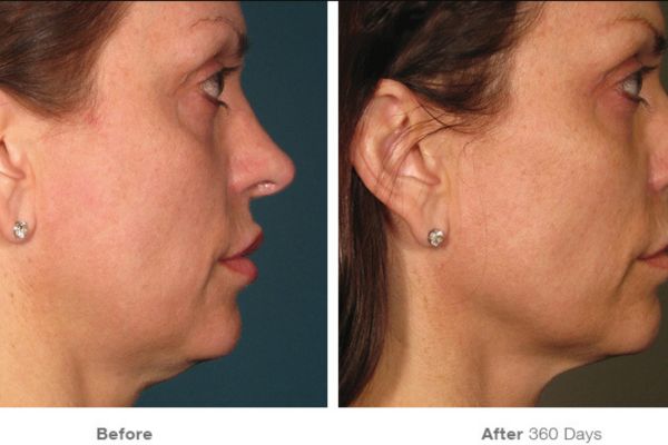 improvements in face and neck zone after ultherapy