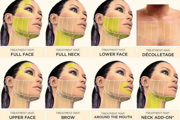 common treatment zones for ultherapy face lift