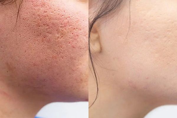 Laser treatment may support acne scar texture over time