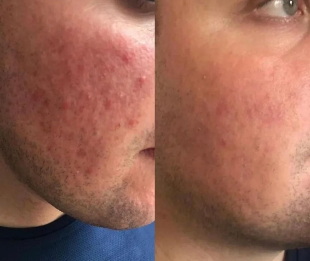 ClearSkin Pro laser by Alma Harmony XL