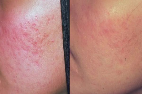 Temporary reactions can vary after laser treatment