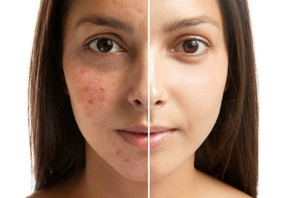 Some acne scars may need a combined treatment plan