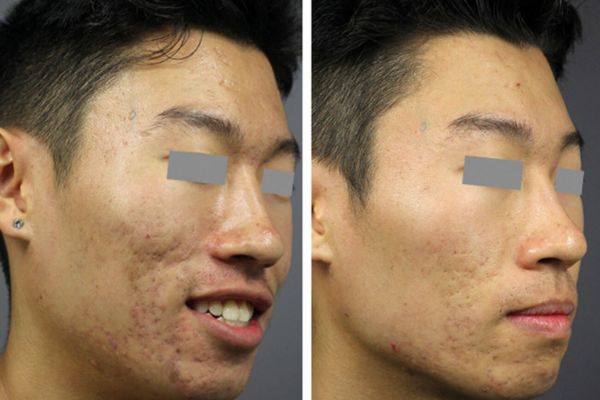 What to expect during a laser acne scar session