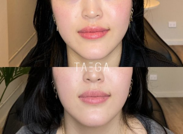 Chin and under-chin profile before HIFU and at follow-up