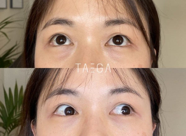 HIFU before and after comparison of the brow and eye area