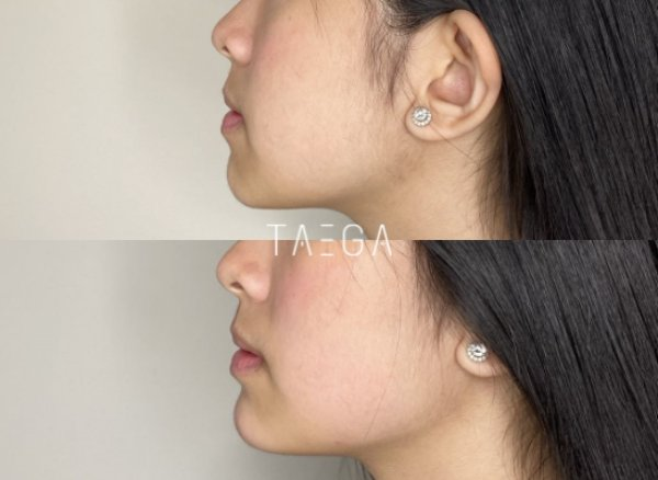 HIFU before and after jowls comparison at follow-up