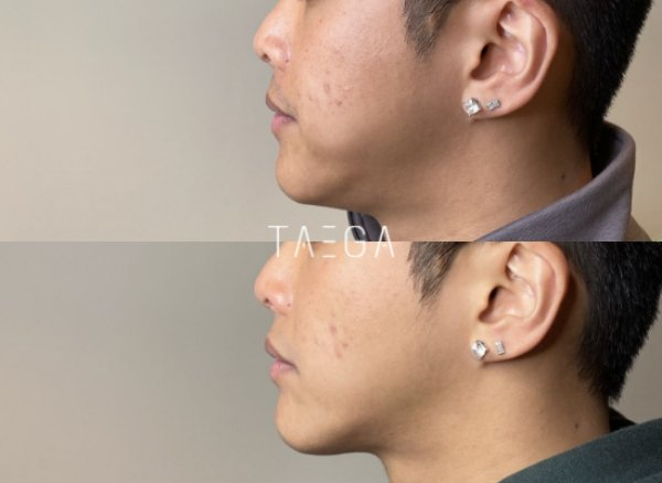 HIFU does not stop the natural skin ageing process