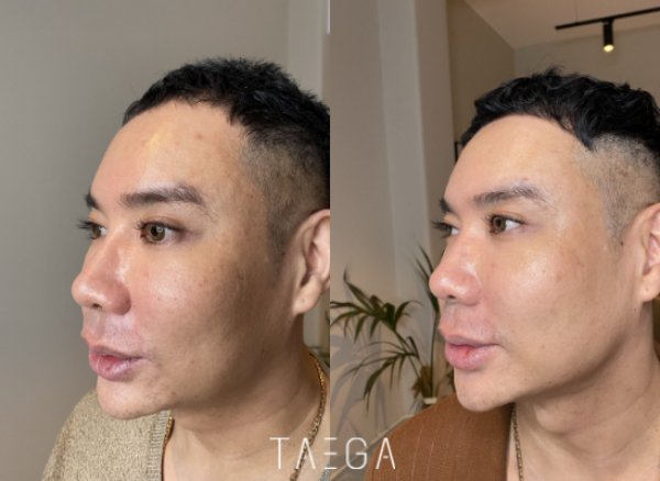 HIFU may improve skin firmness and jawline definition