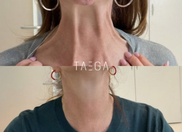 Neck laxity before HIFU and at the planned follow-up